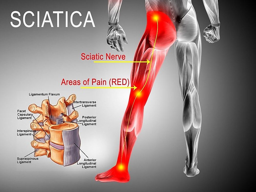 Lower Extremity Pain – Trapped Femoral-Sciatica Nerve — Therapi Tylino